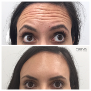 Botox and antiwrinkle treatment