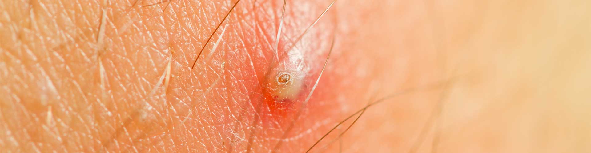 Ingrown Hairs Nova Aesthetic Clinic