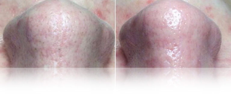 hydrafacial-treatment-before-after-2