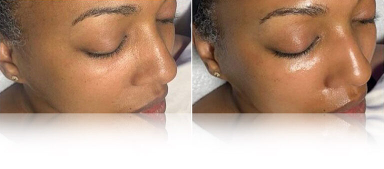 hydrafacial-treatment-before-after