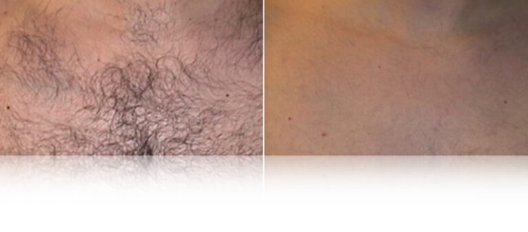 laser-hair-removal-before-after