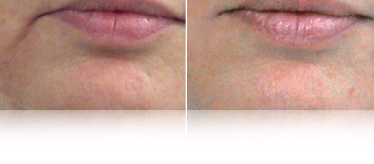 lpg-endermolift-before-after-3