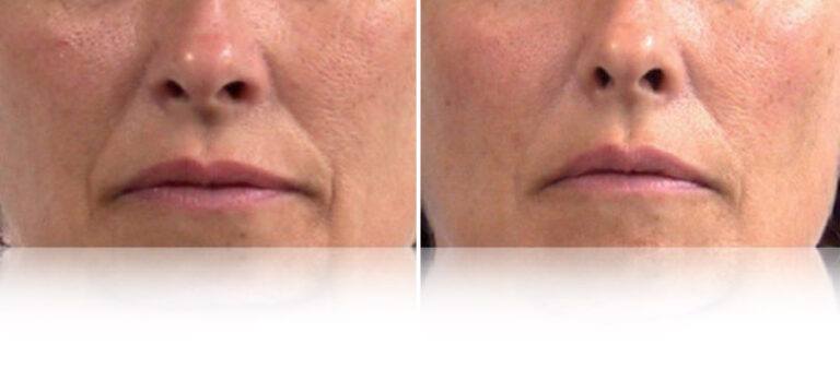 lpg-endermolift-before-after