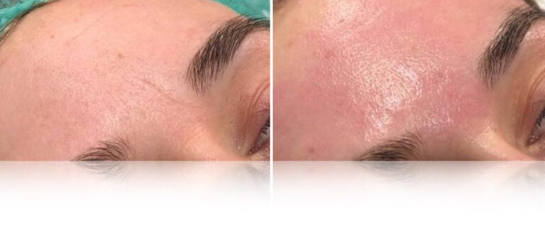 oxygen-facial-before-after-3
